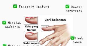 Fenomena Jari dan Kuku: Tanda-Tanda Kesihatan yang Perlu Diperhatikan