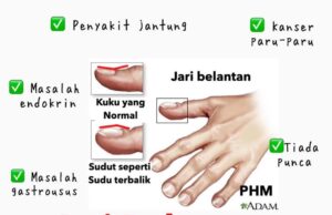 Fenomena Jari dan Kuku: Tanda-Tanda Kesihatan yang Perlu Diperhatikan