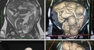 Pengalaman Seorang Wanita Berumur 32 Tahun dalam Menghadapi Cabaran Kesihatan Reproduksi