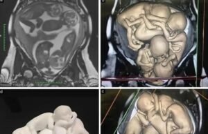 Pengalaman Seorang Wanita Berumur 32 Tahun dalam Menghadapi Cabaran Kesihatan Reproduksi