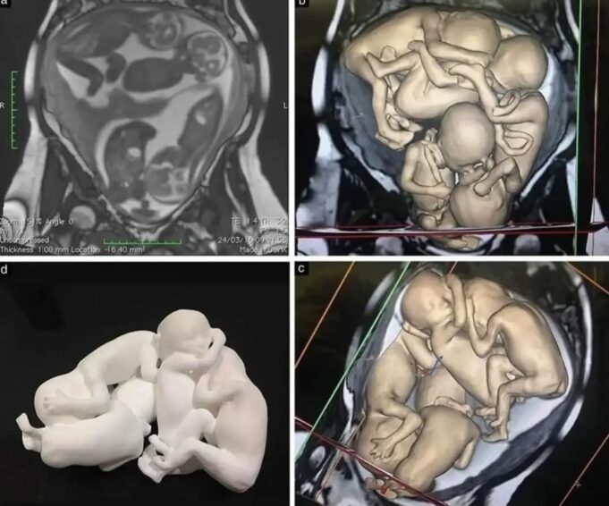 Pengalaman Seorang Wanita Berumur 32 Tahun dalam Menghadapi Cabaran Kesihatan Reproduksi