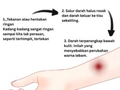 Kenapa Tangan Kita Tiba-Tiba Terjadi Lebam Tanpa Sebab?