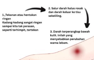 Kenapa Tangan Kita Tiba-Tiba Terjadi Lebam Tanpa Sebab?