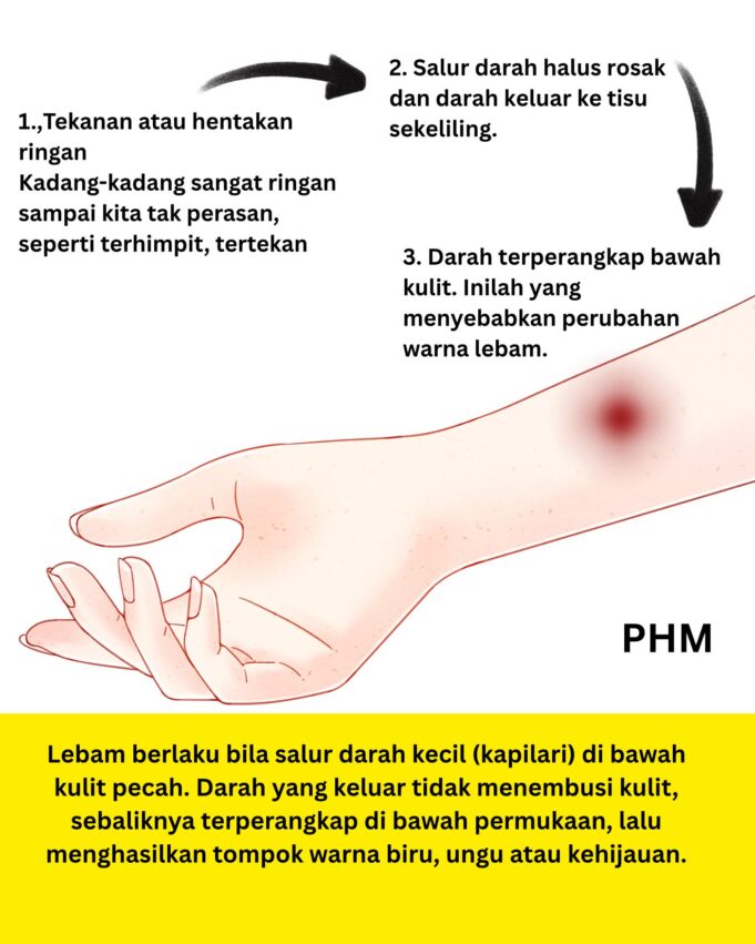 Kenapa Tangan Kita Tiba-Tiba Terjadi Lebam Tanpa Sebab?