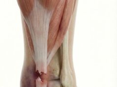 Illustrasi Perubatan: Pecah Lengkap Tendon Achilles