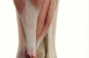 Illustrasi Perubatan: Pecah Lengkap Tendon Achilles