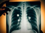Dampak Kesihatan Vaping: Memahami Risiko pada Paru-paru