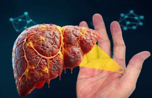 Palmar Erythema: Tanda Amaran Kesihatan dari Tubuh Anda