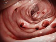Menjaga Kesihatan: Menurut Statistik, 70% Orang Mempunyai Diverticula pada Usia 80 Tahun – Perubahan Diet Kecil yang Bermanfaat