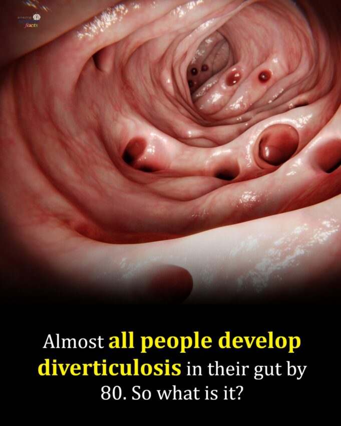 Menjaga Kesihatan: Menurut Statistik, 70% Orang Mempunyai Diverticula pada Usia 80 Tahun – Perubahan Diet Kecil yang Bermanfaat
