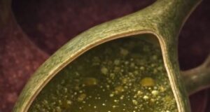 Pembentukan Batu Karang Dalam Pundi Kencing Bile: Menyelami Proses dan Punca