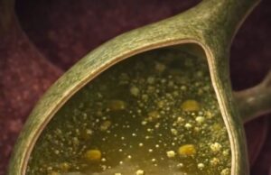 Pembentukan Batu Karang Dalam Pundi Kencing Bile: Menyelami Proses dan Punca