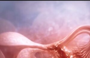 Ectopic Pregnancy: The Hidden Crisis in Women’s Health