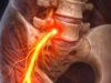 Understanding Sciatica: The Sharp Pain Shooting Down Your Leg