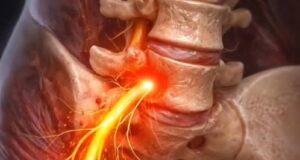 Understanding Sciatica: The Sharp Pain Shooting Down Your Leg