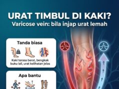 Memahami Urat Varicose: Punca, Gejala, dan Rawatan