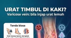 Memahami Urat Varicose: Punca, Gejala, dan Rawatan