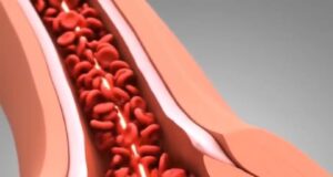 Proses dan Punca Berlakunya Serangan Jantung