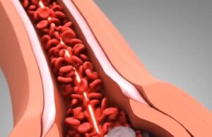 Proses dan Punca Berlakunya Serangan Jantung