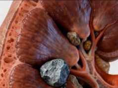 Pembentukan Batu Karang Buah Pinggang: Proses dan Punca