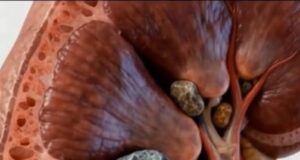 Pembentukan Batu Karang Buah Pinggang: Proses dan Punca