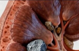 Pembentukan Batu Karang Buah Pinggang: Proses dan Punca