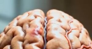 Kesan Tekanan Darah Tinggi Terhadap Kesihatan Otak