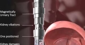 Robot Magnetik Mikroskopik: Inovasi Terbaru dalam Pengubatan Urologi