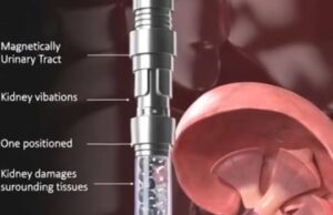 Robot Magnetik Mikroskopik: Inovasi Terbaru dalam Pengubatan Urologi