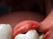 Memahami Pericoronitis: Jangkitan Sakit di Sekitar Gigi Molar yang Belum Sepenuhnya Tumbuh