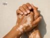 Vitiligo: Memahami Kehilangan Warna Kulit dan Punca-puncanya