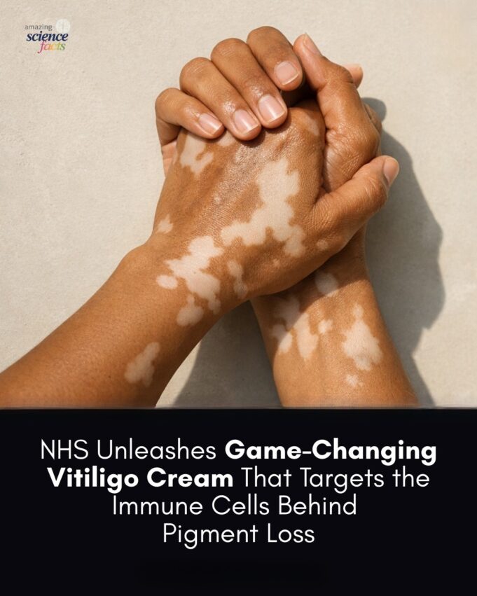 Vitiligo: Memahami Kehilangan Warna Kulit dan Punca-puncanya