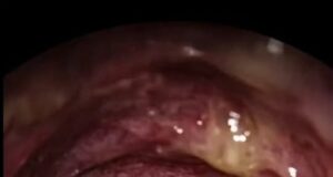 Memahami Asma: Bayangkan Bernafas Melalui Sedutan Kecil