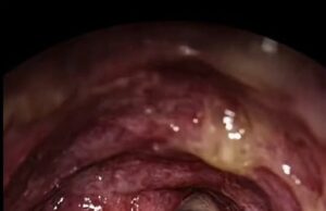 Memahami Asma: Bayangkan Bernafas Melalui Sedutan Kecil