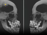 Hyperdontia: Memahami Keadaan Gigi Berlebihan