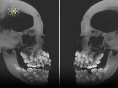 Hyperdontia: Memahami Keadaan Gigi Berlebihan