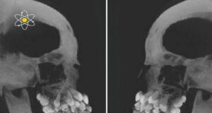 Hyperdontia: Memahami Keadaan Gigi Berlebihan