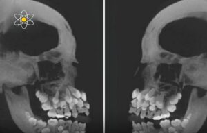 Hyperdontia: Memahami Keadaan Gigi Berlebihan
