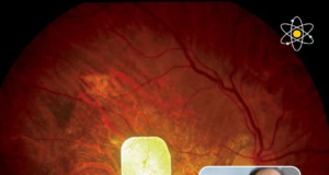 PRIMA System: Teknologi Baru untuk Memulihkan Sel yang Berguna