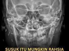 Bahaya Susuk: Mengapa X-ray Mampu Mengesannya