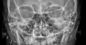 Bahaya Susuk: Mengapa X-ray Mampu Mengesannya